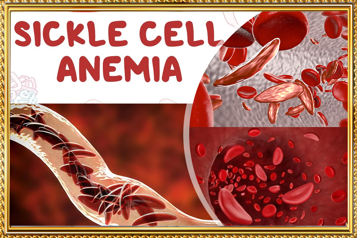 https://sgcart.xyz/How Medical Genetics Helps Manage Sickle Cell Anemia